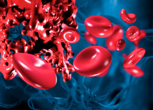 filtro ivc coágulo de sangre