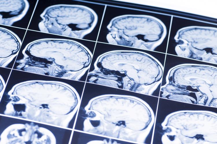 una tabla que muestra imágenes de una resonancia magnética en busca de lesiones cerebrales traumáticas.