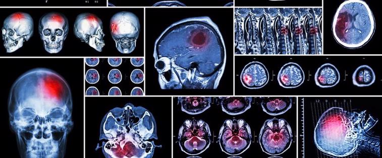 Brain scans showing a traumatic brain injury